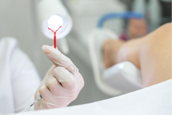 Ini Penyebab IUD Bisa Lepas Sendiri 